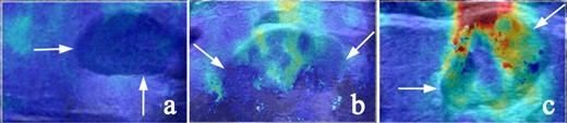 Representative SWE images of internal color homogeneity (Ehomo) of the lesions (white arrow). (a) Very homogeneous, (b) reasonably homogeneous, and (c) heterogeneous. SWE, shear wave elastography.