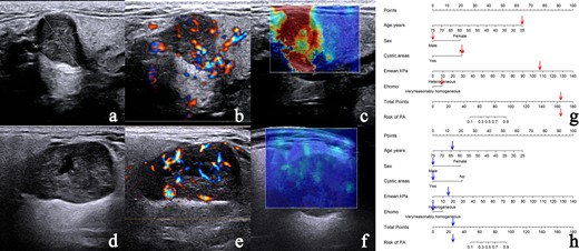 The nomogram accurately differentiates PA from WT. (a–c) Case 1: a 25-year-old male with pathologically confirmed PA. (a) CUS image shows a regular nodule with clear border and absent of cystic areas. (b) CDFI demonstrates Grade 3 vascularity with mixed vascular distribution could be seen in the nodule. (c) SWE image showing heterogeneous Ehomo with Emean of 107.5 kPa. (d–f) Case 2: a 64-year-old male with pathologically confirmed WT. (d) CUS image shows a regular nodule with clear border and cystic areas. (e) CDFI demonstrates Grade 3 vascularity with mixed vascular distribution could be seen in the nodule. (f) SWE image demonstrates very homogeneous Ehomo with Emean of 16.5 kPa. According to the nomogram model, the prediction probability of PA is greater than 90.00% (g) in Case 1 and less than 10.00% (h) in Case 2. CDFI, color Doppler flow imaging; CUS, conventional ultrasound; PA, pleomorphic adenoma; SWE, shear wave elastography; WT, Warthin’s tumor.