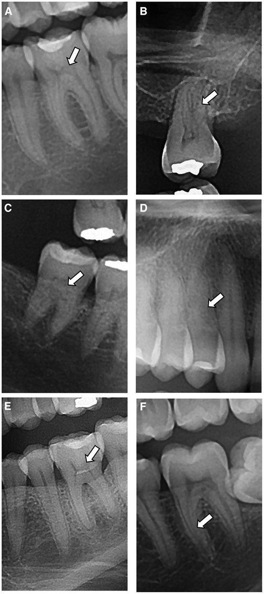 Identification and classification of pulp calcifications in posterior ...