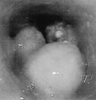 Endoscopic examination reveals a circular type 3 tumor in the upper intrathoracic esophageal wall.