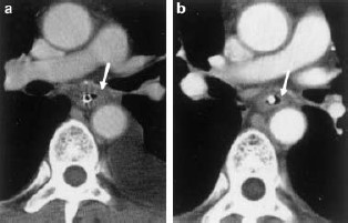 A computed tomography scan reveals the primary tumor invading to the left main bronchus (a, arrow). The reduction rate after chemotherapy is approximately 45% (b, arrow).
