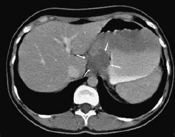 Axial post-contrast CT scan demonstrating an ill-defined, homogeneous hypodense mass (arrows) protruding through the gastric lumen. No prominent contrast enhancement or calcification is detected within the lesion.