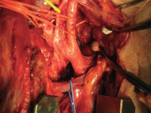 Operative field after dissection of lymph nodes along the right recurrent nerve. An inverted L-shaped partial sternotomy was added to obtain a good view of full length of the recurrent nerve.
