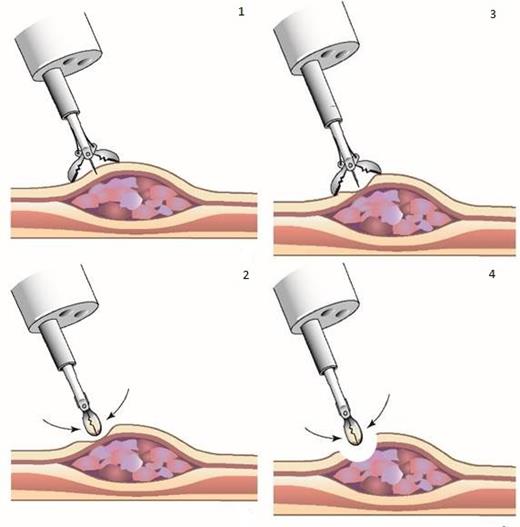 Bite-on-bite biopsies (1 + 2 + 3 + 4) supposedly increase the chance of detecting submucosal tumor deposits compared to conventional biopsies (1 + 2).