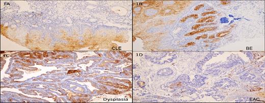 The immunohistochemical expression of CEACAM6. 1 (A), Focal positive expression in CLE. 1 (B); Strong membranous and cytoplasmic expression in BE. 1 (C) Strong membranous and cytoplasmic expression in dysplasia. 1 (D) Negative expression in adenocarcinoma.