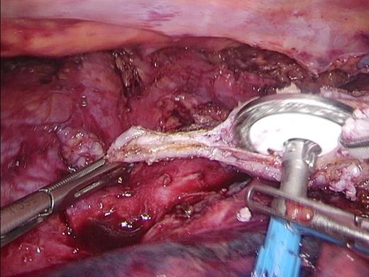 Introduction of the Anvil. The 28 mm Anvil is introduced into the esophagus after removing the staple line.