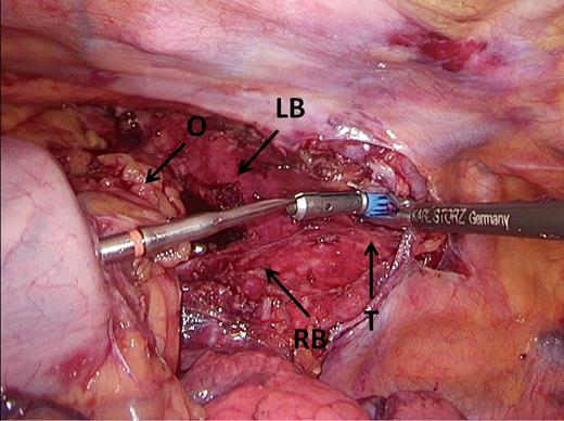 Docking. Omental tissue is positioned ventrally from the gastric tube, covering the bronchus and trachea, and the trocar is perforated just dorsal to the omental tissue. LB, left main stem bronchus; O, omental tissue, RB, right main stem bronchus, T, trachea.