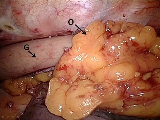 Omental wrap. Omental tissue is draped around the dorsal side of the anastomosis and fixated onto the pleura in order to create a 360° omentoplasty. G, gastric tube; O, omental tissue.