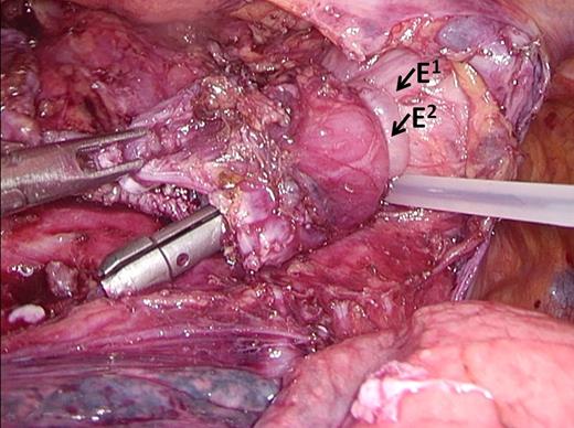 Endoloops. The anvil is secured in the esophagus by two endoloops. E1 = Endoloop 1, E2 = Endoloop 2.