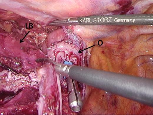Excision of redundant tissue. Redundant esophageal tissue is excised to prevent interposition into the staple line. LB, left main stem bronchus; O, esophagus.