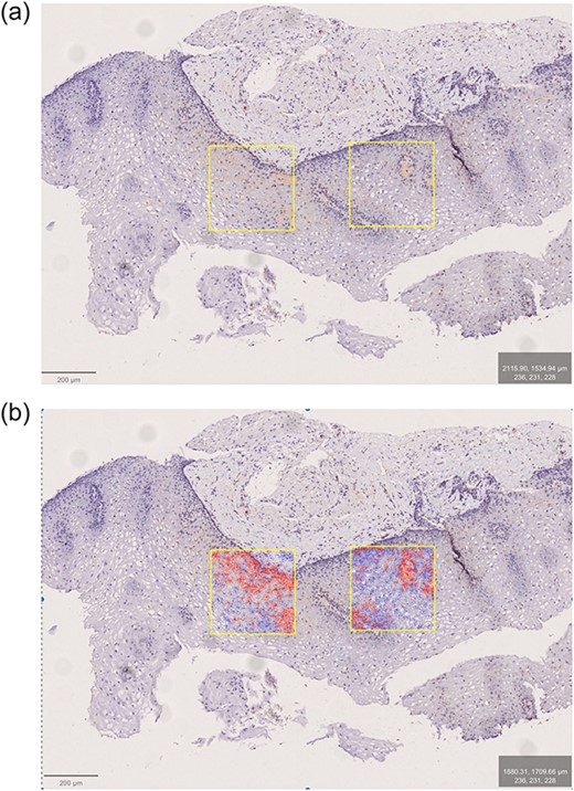EoE patient. Antibody: eosinophilic peroxydase (EPX). The two most affected ROIs marked before (a) and after (b) positive cell detection.