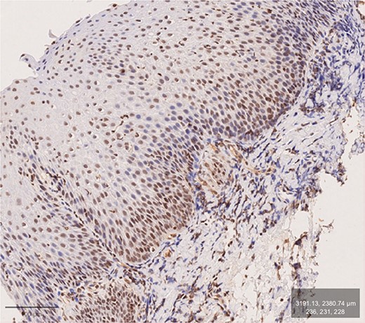 GERD patient. Antibody: inducible nitric oxide synthase (iNOS). Brownish DAB-stain of basal layers and adjoining submucosa. Distinct DIS (mainly in middle layers).