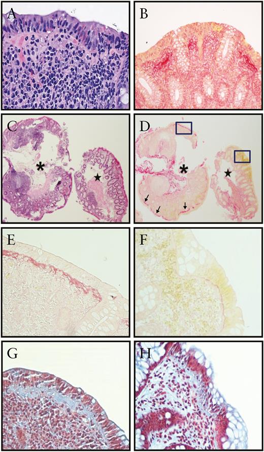 Collagenous colitis featuring lamina propria lymphoplasmacytosis, preserved crypt density and architecture, ‘basket weave’ subepithelial fibrosis and intraepithelial lymphocytosis [a, H&E; b, Sirius red, 20×]. Paired biopsy samples of involved [∗] [thickened subepithelial collagen band marked by arrows] and uninvolved mucosa [★] were selected for analysis [c, H&E; d, Sirius red, 4×]. Higher magnification of the framed box area marked in d is shown in e [involved mucosa, Sirius red, 40×] and f [uninvolved mucosa, Sirius red, 40×]. Masson Trichrome staining on the same area is shown in g [involved mucosa, 40×] and h [uninvolved mucosa, 40×].
