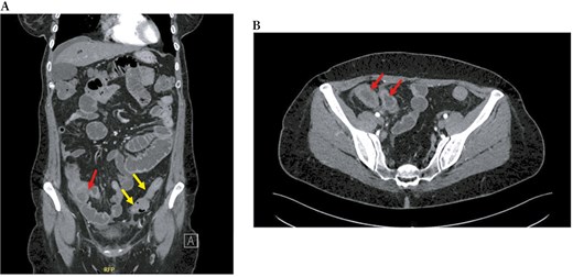 Computed tomography scan, in coronal (A) and transversal (B) sections, shows both a thickening of the last ileal loop for 5 cm in length with enhancement in the arterial phase (red arrows) and a concentric parietal thickening of the sigmoid colon (yellow arrows).