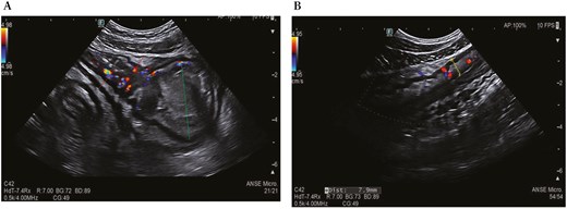 Intestinal ultrasound shows thickening of the terminal ileum (red dotted line) with increased vascularization and upstream dilation (green dotted line) (A) and parietal thickening of the sigmoid colon up to 7.9 mm (yellow dotted line) with increased vascularization in the submucosa and narrowing of the lumen (B).