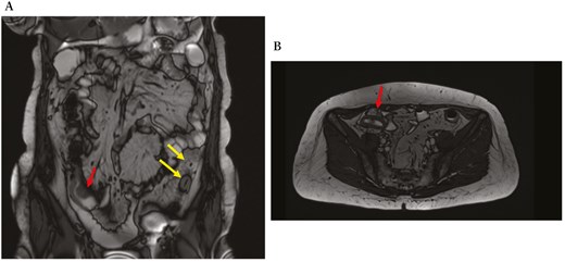 Magnetic resonance enterography, in coronal (A) and transversal (B) sections, shows concentric stricture with the enhancement of the ileocecal valve and terminal ileum (red arrows) and stricture of the sigmoid colon extending over a length of 7 cm (yellow arrows).