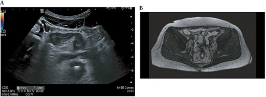 Intestinal ultrasound (A) and magnetic resonance enterography (B) show a wall thickening of the rectum up to 7.3 mm (red dotted lines).