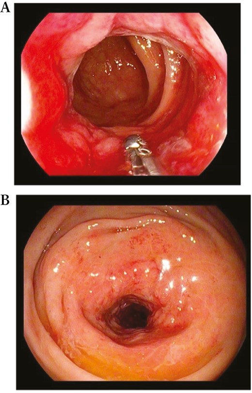 Endoscopic view of a passable stenosis of the rectum extending from 12 to 10 cm from the anal verge.