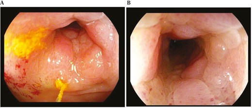 Endoscopic view of a non-passable stenosis of the sigmoid colon at 30 cm from the anal verge.