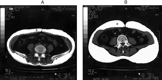 Computed tomography showing cross-sectional abdominal areas at umbilicus level in two patients demonstrating variation in fat distribution. A, Visceral type (49-yr-old female, 23.1 of BMI, visceral fat area: 146 cm2; subcutaneous fat area, 115 cm2; V/S ratio, 1.27). B, Subcutaneous type (40-yr-old female, 24.0 of BMI, visceral fat area: 60 cm2; subcutaneous fat area, 190 cm2; V/S ratio, 0.31).