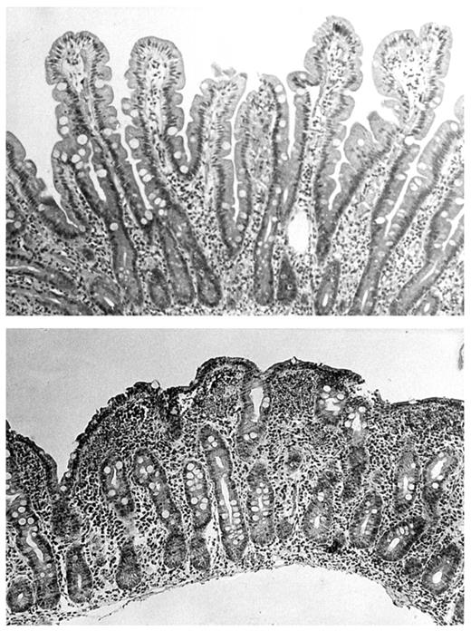 Top, Normal small-bowel biopsy with finger-like villi. Bottom, Small-bowel biopsy from a patient with celiac disease showing villous atrophy and hypertrophy of crypts.
