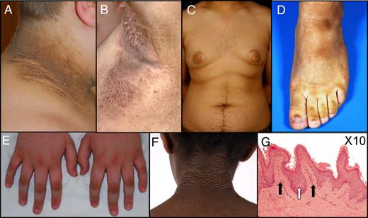 Acanthosis nigricans (AN) in severe IR. A, Severe AN on the neck in a prepubertal patient with autosomal dominant IR of unknown cause. B, AN associated with exuberant axillary acrochordons in a 50-yr-old male with severe IR of unknown cause. C–F, AN in abdominal skin flexures of a 15-yr-old boy with severe IR due to a heterozygous INSR mutation (C), on the foot of a patient with congenital generalized lipodystrophy and severe IR due to homozygous AGPAT2 mutations (D), on the knuckles in a prepubertal patient with severe IR of unknown cause (E), and on the neck of a prepubertal girl with RMS due to a homozygous INSR mutation (F). G, Histological appearances from a nuchal skin biopsy showing characteristic papillomatosis (solid arrows), hyperkeratosis, and some acanthosis (open arrow). [Histological image courtesy of Dr. Ed Rytina.].