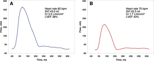 Flow curves in the ascending aorta in two cases after left anterior descending artery infarction presenting with greatly diverging haemodynamics and similar left ventricular ejection fraction. (Patient A) A 41-year-old male presented after a delay of 100 min (cine magnetic resonance imaging Supplementary material online, Videos S1–S3). (Patient B) A 60-year-old male was intervened after a delay of 280 min (cine magnetic resonance imaging Supplementary material online, Videos S4–S6). CI, cardiac index ; LVEF, left ventricular ejection fraction; SVI, stroke volume index.