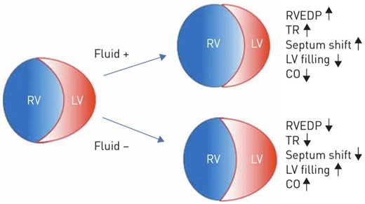Effects of volume changes on the right ventricular geometry and haemodynamics. Reproduced from Olsson KM, Halank M, Egenlauf B, et al. Decompensated right heart failure, intensive care and perioperative management in patients with pulmonary hypertension: updated recommendations from the Cologne Consensus Conference 2018. Int J Cardiol 2018; 272S: 46–52.16