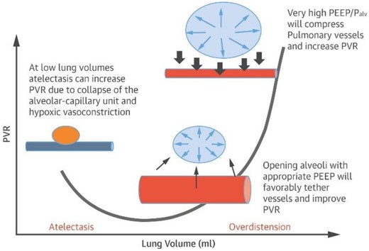 Relationship between alveolar volume/pressure and pulmonary vascular resistance. Adapted from Alviar et al.27 PVR, Pulmonary vascular resistance; PEEP, positive end expiratory pressure; Palv, alveolar pressure. Blue vessel represents deoxygenated blood.