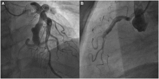 (A) Left coronary angiogram showing massive coronary artery ectasia of the LAD and Cx. (B) Right coronary angiogram showing coronary artery ectasia in the RCA and distal thrombus.