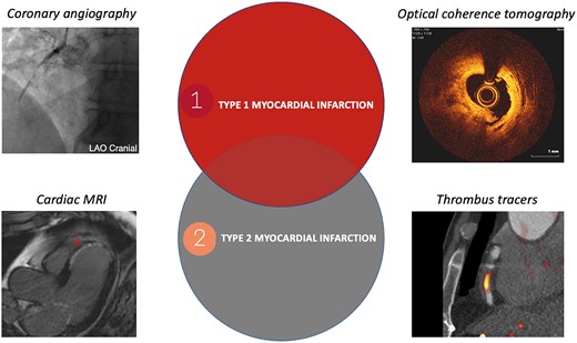 Differentiating type 1 and type 2 myocardial infarction; delineating the ‘grey zone’ using imaging. Coronary angiography demonstrating a thrombotic occlusion in a right coronary artery; cardiac magnetic resonance imaging demonstrating near transmural anteroseptal late gadolinium enhancement; optical coherence tomography demonstrating atherosclerotic plaque rupture and thrombosis; positron emission tomography/computed tomography scan demonstrating thrombus using 18F-GP1 thrombus tracer in a circumflex coronary artery in a patient with type 1 myocardial infarction.