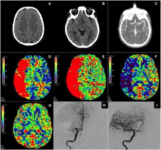 (A–I) Right middle cerebral artery occlusion with no infarct core and large penumbra, due to good collateral circulation. Automated computed tomography perfusion software packages with different algorithms that calculate infarct core and penumbra volumes are used. The input variables for these algorithms are the following computed tomography perfusion variables: CBV (cerebral blood volume, mL/100 g), CBF (cerebral blood flow, mL/100 g/min), MTT (mean transit time, s), and TTP (time to peak, s). (A) Non-contrast computed tomography scan: no early signs of ischaemia. (B) Non-contrast computed tomography scan: dense vessel sign (right middle cerebral artery). (C) Computed tomography angiography: proximal right middle cerebral artery occlusion with collateral circulation in distal middle cerebral artery branches. (D) Computed tomography perfusion, time to peak: delayed contrast peak in the right middle cerebral artery area, compatible with area at risk for infarction (penumbra and potential infarct core together). (E) Computed tomography perfusion, mean transit time: slow contrast transit in right middle cerebral artery area, compatible with area at risk for infarction (penumbra and potential infarct core together). (F) Computed tomography perfusion, cerebral blood flow: diminished cerebral blood flow in the right middle cerebral artery area, compatible with area at risk for infarction (penumbra and potential infarct core together). (G) Computed tomography perfusion, cerebral blood volume: no marked defect in relative cerebral blood volume in the right middle cerebral artery area, compatible with no important infarct core. (H) Digital subtraction angiography, start of intra-arterial thrombectomy procedure: proximal right middle cerebral artery occlusion with collateral flow through the ACA-middle cerebral artery anastomosis. (I) Digital subtraction angiography, end of intra-arterial thrombectomy procedure: recanalization of right middle cerebral artery occlusion with complete perfusion of middle cerebral artery without delay (TICI 3).