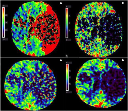 (A–D) Left middle cerebral artery occlusion with mainly infarct core and almost no penumbra. (A) Computed tomography perfusion, time to peak: delayed contrast peak in left middle cerebral artery area, compatible with area at risk for infarction (penumbra and potential infarct core together). (B) Computed tomography perfusion, mean transit time: no contrast transit in the left middle cerebral artery area (mean transit time drop out), compatible with infarction core. (C) Computed tomography perfusion, cerebral blood flow: diminished cerebral blood flow in left middle cerebral artery area, compatible with area at risk for infarction (penumbra and potential infarct core together). (D) Computed tomography perfusion, cerebral blood volume: marked defect in relative cerebral blood volume in left middle cerebral artery, compatible with infarct core.