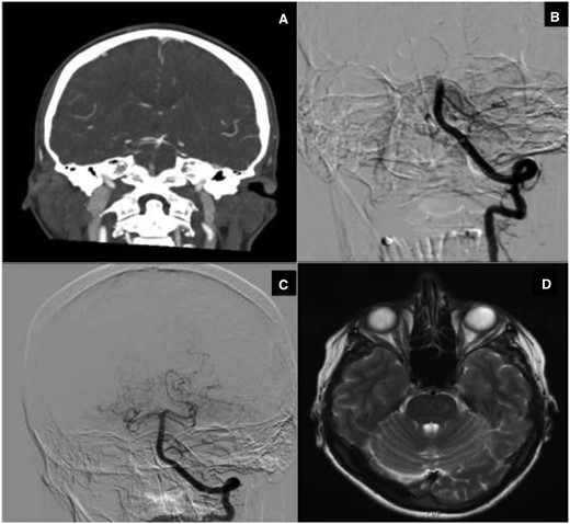 (A–D) Basilar artery thrombosis. (A) Computed tomography angiography: basilar artery occlusion with open basilar top (via collateral flow from anterior circulation). (B) Digital subtraction angiography (start intra-arterial thrombectomy procedure): mid basilar artery occlusion (open posterior inferior cerebellar artery). (C) Digital subtraction angiography (end intra-arterial thrombectomy procedure): open basilar artery. (D) Magnetic resonance imaging (T2-weighted image): no ischaemic damage brainstem at the level of the pons.