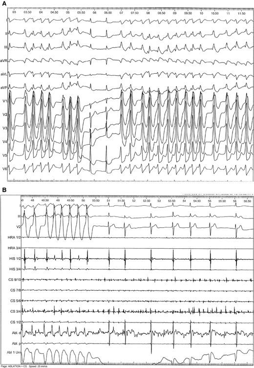 (A) Unusual mechanism of wide QRS tachycardia. Fast atrioventricular conduction of atrial fibrillation via a left-sided posterolateral bypass tract causing a wide QRS tachycardia. Of note, QRS complexes vary in QRS width and the RR intervals are absolute irregular. Intermittently, there is conduction through the AV node, which causes regular QRS complexes during tachycardia. This phenomenon must be differentiated from true fusion beats, which would prove the presence of VT. (B) Catheter ablation a left-sided posterolateral bypass tract (Abl. d = distal ablation catheter) causes narrowing of the QRS complexes. Different intracardiac electrograms are also shown (HRA, HIS, CS). Thereafter, atrial fibrillation is conducted through the AV node only, causing slowing of the ventricular response due to decremental conduction properties of the AV node.