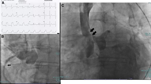 (A) is the patient's 12- lead electrocardiogram. (B) is the JR-4 guided luminogram of the aortic root. (C) is the pigtail aortogram.