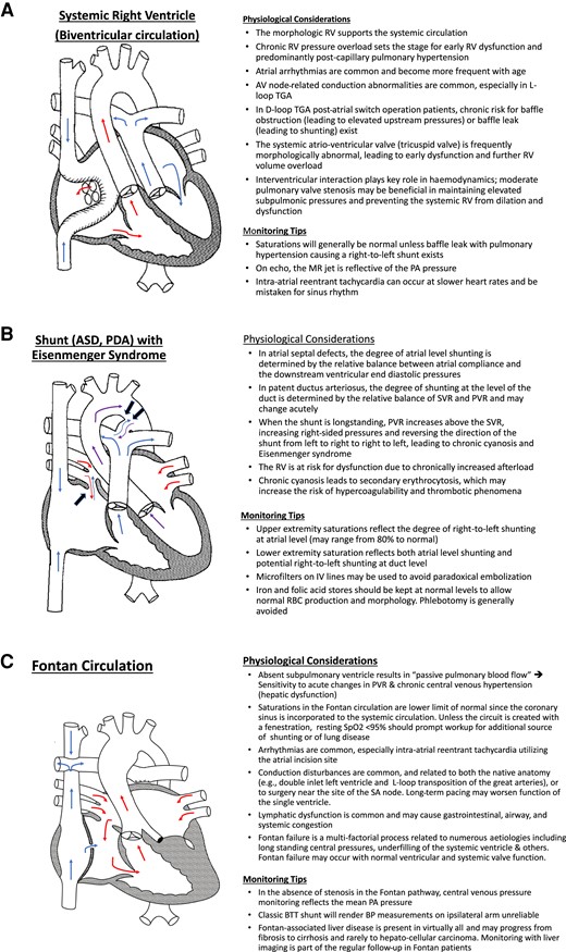 Key physiologic and monitoring considerations in selected congenital heart disease conditions. (A) In the example shown, the patient’s native anatomy was that of {S, D, D} transposition of the great arteries. Atrial-level switch procedures (‘Mustard’ and ‘Senning’) utilize intracardiac rerouting via a ‘baffle’ to redirect blood flow. The SVC and the IVC transport deoxygenated blood and direct it through the mitral valve to the left ventricle and out the PA. Surgical removal of the atrial septum allows pulmonary venous return to traverse from posterior left atrium through the space in the systemic venous baffle through the tricuspid valve to the right ventricle and out the aorta. RV, right ventricle; TGA, transposition of the great arteries; MR, mitral regurgitation; PA, pulmonary artery. (B) The presence of an unrestricted left-to-right shunt through an atrial septal defect (large arrow) or through a patent ductus arteriosus (two large arrows) leads to increased pulmonary blood flow, gradual pressure build-up, and vessel remodelling in the pulmonary vasculature. If left untreated, an increase in the PVR and shunt reversal (blue arrow at the atrial septal defect and purple arrow at the level of the patent ductus arteriosus) follows. ASD, atrial septal defect; PDA, patent ductus arteriosus; SVR, systemic vascular resistance, PVR, pulmonary vascular resistance; IV, intravenous. (C) In the example shown, the patient’s native anatomy was that of {S, D, S} mitral atresia, aortic atresia, and aortic arch hypoplasia resulting in hypoplastic left heart syndrome. The patient’s prior surgical palliation consisted of a Stage 1 or Norwood operation (atrial septectomy, Damus–Kaye–Stansel anastomosis of ascending aorta to main pulmonary artery with ligation and oversewing of distal main pulmonary artery, and aortic arch reconstruction) followed by a Glenn (superocavopulmonary) anastomosis and finally completion of a fenestrated, lateral tunnel Fontan circulation (inferocavopulmonary anastomosis). BTT, Blalock–Taussig–Thomas.