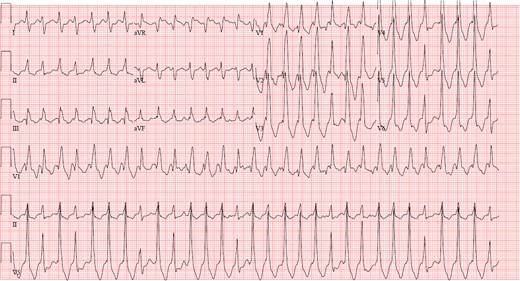 Electrocardiogram demonstrating intra-atrial reentrant tachycardia in a patient with D-loop transposition of the great arteries s/p atrial switch operation.