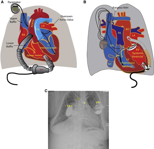 Illustration detailing the orientation of ventricular assist device (VAD) placement and the direction of blood flow using an axial flow HeartMate II (Abbott Laboratories, Chicago, Illinois) in a patient with d-transposition of the great arteries (TGA) with atrial switch (A) and a centrifugal flow HVAD (Medtronic Inc., Minnesota, Minnesota) in an l-TGA (B). Reprinted with permission from Menachem et al. AO, aorta; CS, coronary sinus; IVC, inferior vena cava; LA, left atrium; LV, left ventricle; PA, pulmonary artery; RA right atrium. (C) Chest radiograph from an adult with pulmonary atresia with intact ventricular septum s/p transcatheter pulmonary valve implantation (*), CRT-D implantation (**), and right ventricular HeartWare VAD implantation (***). A right central line present (arrow).