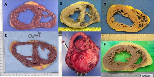 Anatomopathological study of explanted hearts. (A) Primary dilated cardiomyopathy, without overt fibrosis; (B and C) ischaemic cardiomyopathies with macroscopic fibrotic lesions; (D) lamin A/C mutation cardiomyopathy, in a patient with radiofrequency ablation failure (radiofrequency ablation lesions can be observed in the septal and lateral walls); (E) primary dilated cardiomyopathy with HeartMate 3; (F) primary dilated cardiomyopathy, with fibrosis in the posterior wall.