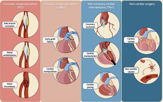 Aetiologies of periprocedural myocardial infarction and injury in cardiac and non-cardiac interventions. The figure illustrates different aetiologies underlying periprocedural myocardial infarction and injury in cardiac (i.e. percutaneous coronary intervention, coronary artery bypass grafting, transcatheter aortic valve implantation) and non-cardiac interventions. Abbreviations: CABG, coronary artery bypass grafting; PCI, percutaneous coronary intervention; TAVI, transcatheter aortic valve implantation.