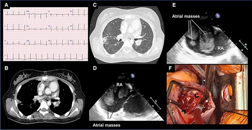 (A) 12-lead electrocardiogram demonstrates sinus tachycardia. (B, C) Axial chest computed tomography images reveal a subsegmental pulmonary embolism. (D, E) Transesophageal echocardiogram (0º and 90º, respectively) display multiple free-floating masses in the right atrium. (F) An intraoperative image depicts an open right atrium containing several pedunculated and sessile masses (indicated by arrowheads).