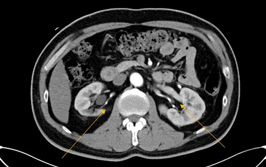 CT abdomen showing saccular aneurysms at renal arteries.