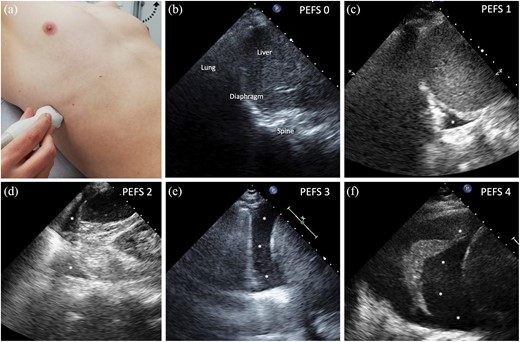 PEF score examples. Patient and probe positioning for PEF assessment (a). Example for increasing PEF scores assessed on thoracic ultrasound from 0 to 4 (b–f). Asterisk represents pleural fluid. PEF: pleural effusion score.