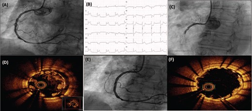 Angiographic, electrocardiographic, and optical coherence tomography image composition.
