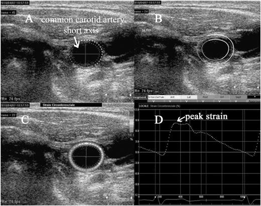 An example of evaluation of carotid circumferential strain. Short axis of the common carotid artery, immediately before the carotid bulb. The region of interest (ROI) is manually drawn along the intima–blood interface, with subsequent adjustment of the width of the region of interest (A); the software automatically checks the appropriate tracking along segments in which the region of interest is divided (B); is then performed the calculation of the strain, that appears in colour scale at the level of ROI, according to the degree of distension of the vessel during systole (C); is then displayed a curve of average strain along the region of interest during the cardiac cycle, with the possibility to measure the peak systolic value (D).
