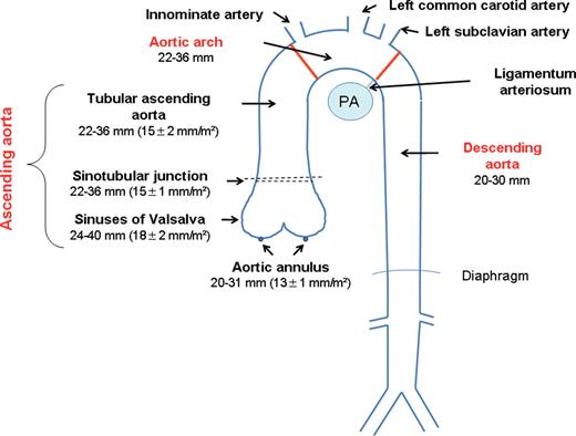 Normal size of thoracic aortic segments. The thoracic aorta can be divided into three segments: the ascending aorta that extends from the aortic annulus to the innominate artery and is typically measured at the level of the aortic annulus, the sinuses of Valsalva, the sinotubular junction, and the proximal (tubular) ascending aorta; the aortic arch that extends from the innominate artery to the ligamentum arteriosum; and the descending aorta that extends from the ligamentum arteriosum to the level of the diaphragm. PA, right pulmonary artery. Modified from Diseases of the aorta. In: Feigenbaum H, Armstrong WF, Ryan T, eds. Feigenbaum's Echocardiography. 6th ed. Philadelphia, PA: Lippincott Williams & Wilkins; 2005. p673; Ascending aorta values from Erbel et al.46