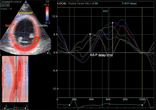 Preoperative two-dimensional ST-RS echocardiography in the mid-LV short axis. AS-P delay, anteroseptal (yellow) to posterior (magenta) time delay; AVC, aortic valve closure; LV, left ventricular; ST-RS, speckle tracking radial strain.