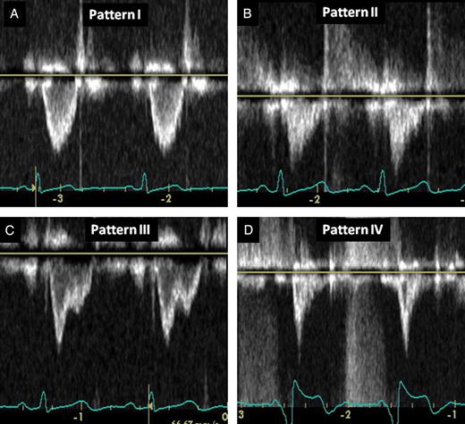 Visual inspection of right ventricular outflow tract Doppler spectral ...