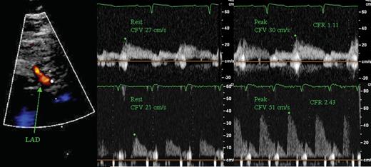 Example of CFR echocardiography. Left: colour Doppler of LAD. Pulsed-wave recording of CFV and measurement of peak CFV before and during adenosine infusion in a patient with low (top) and normal (bottom) CFR.